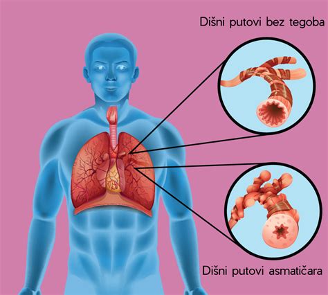 Astma Simptomi Uzroci Terapija Prirodno Lije Enje Hedera Hedera