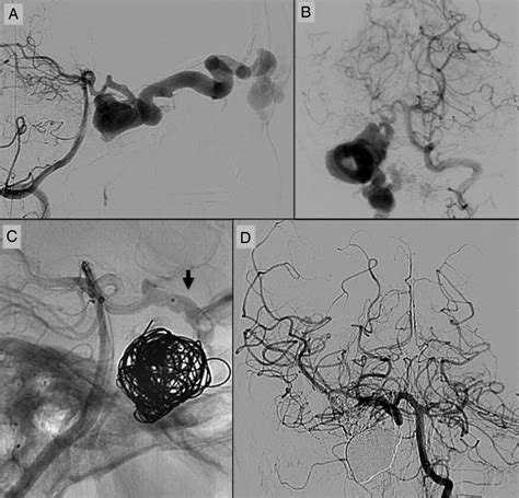 Carotid Cavernous Fistula Treatment Pregnancy Informations