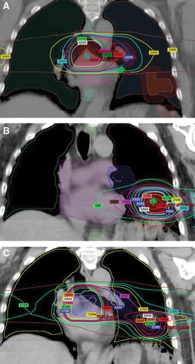 Pseudoprogression After Stereotactic Body Radiotherapy Journal Of