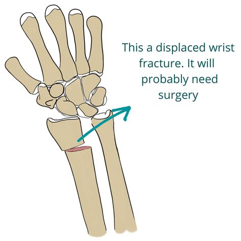 Wrist Fractures Distal Radius Fractures Pro Doctor