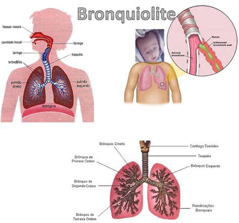 O Que E Bronquiolite Em Bebe - Cantinho do Bebê: Bronquiolite...no 6º Mês do Gui