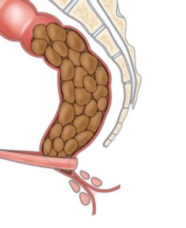 Intestino Preso Após Cirurgia - Intestino Preso Após Cirurgia: Dicas e Cuidados Para Resolver o Problema