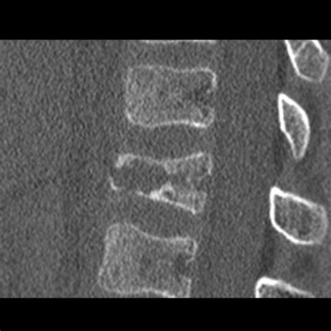 Eosinophilic Granuloma Of Spine