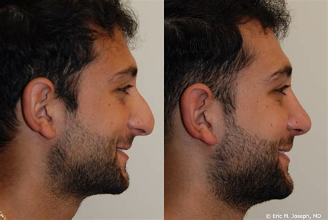 Eric M Joseph Md Rhinoplasty Before And After 3 Months After Male