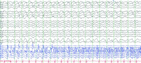 Periodic Eeg Patterns Neupsy Key