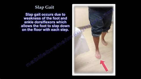 Stamping Gait Causes : Gait Abnormality Ppt Video Online Download / A ...