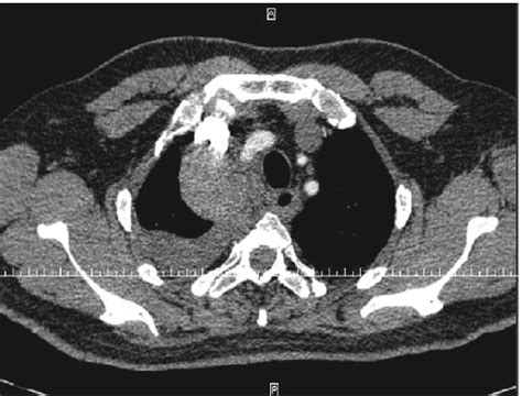 Figure From Spontaneous Hemothorax In A Patient With Von