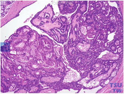 乳腺导管内乳头状肿瘤 癌 乳腺肿瘤学 天山医学院