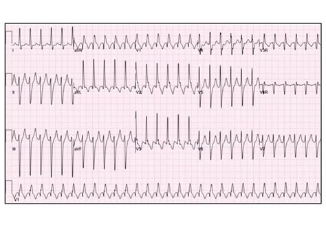 Pediatric Ventricular Arrhythmia In A Normal Heart Mayo Clinic