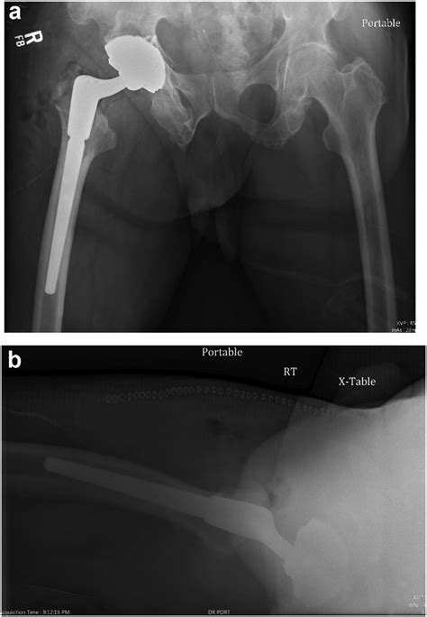 A Postoperative Ap Right Hip Radiograph Following The Second Revision