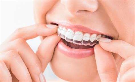 Ortodoncia Invisible Y Removible Con F Rula Invisalign