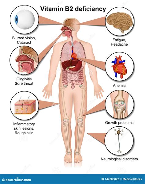 Vitamin B2 Deficiency Infographic 3d Medical Illustration On White