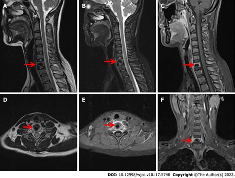 Abnormal Cervical Spine Mri