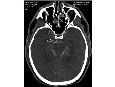 Missing Posterior Communicating Artery