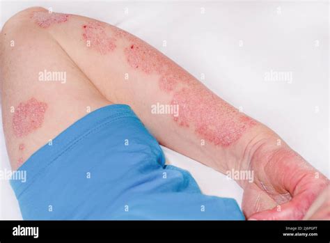 Psoriasis Aguda En El Brazo De Un Hombre Enrojecimiento Severo En La