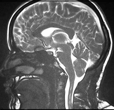 Chiari Malformation And Syringomyelia What You Should Know The Spine Practice Of Jpatrick