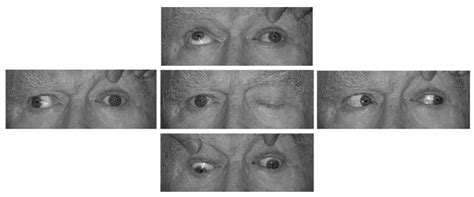 Approach To The Patient With Diplopia Neupsy Key