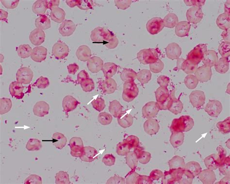 Haemophilus influenzae in a blood culture. The H influenza are tiny ...