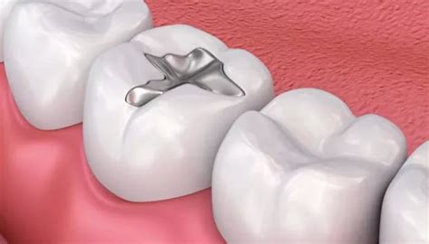 How Much Does Teeth Filling Cost In India? - Dailytoothcare.com