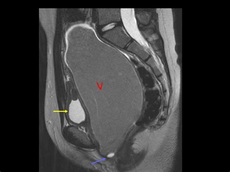 haematocolpos presenting  acute urinary retension   pain eurorad