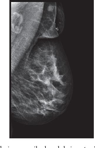 Figure 1 From A Nonpalpable Nodule In Ectopic Axillary Breast Tissue