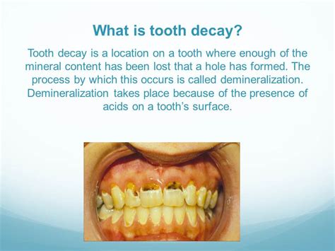 Diet & Tooth Decay - Ithaca, MI | Pine River Dental Care