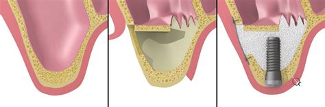 Sinus Lift Extern Dental Premier