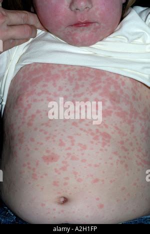 PENICILLIN ALLERGY RASH Stock Photo: 52251238 - Alamy