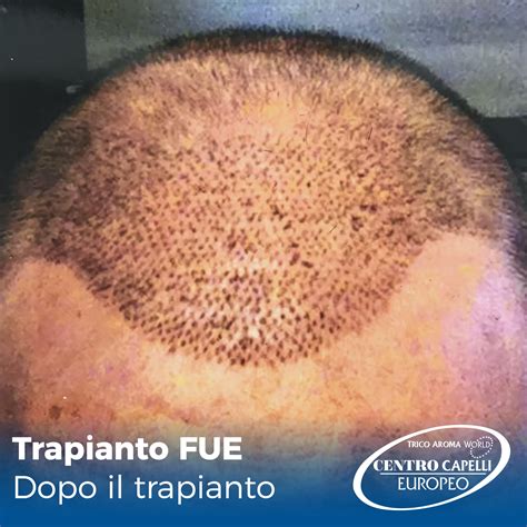 Trapianto Capelli Milano - Clinica Salutati - Centro Capelli Europeo