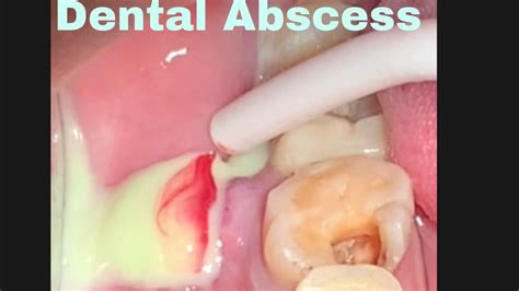 Dental Abscess Drain YouTube