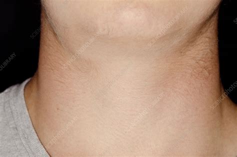 Swollen Lymph Nodes Posterior Neck