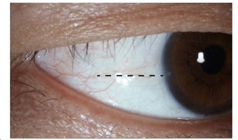 A picture demonstrates the temporal corneal limbus. The black dotted ...