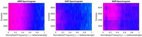 Diagnostics Free Full Text Deep Learning Based Arrhythmia Detection