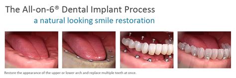 All On 6 Dental Implants NYC Full Mouth Dental Implants