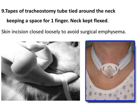 Ppt Tracheostomy Powerpoint Presentation Free Download Id 325341