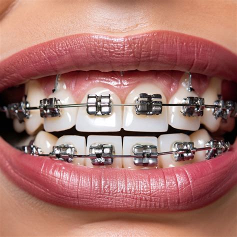 Traditional Metal Braces In Pembroke Pines And Plantation Orthodontist