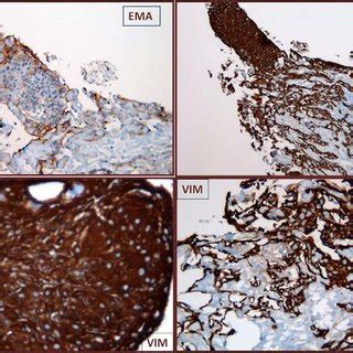 Immunohistochemistry Showed A Diffuse Positivity For Anti Vimentin