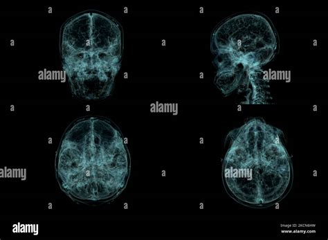 Collection Of Human Skull Brain By Ct Scan X Ray Visualization Inside