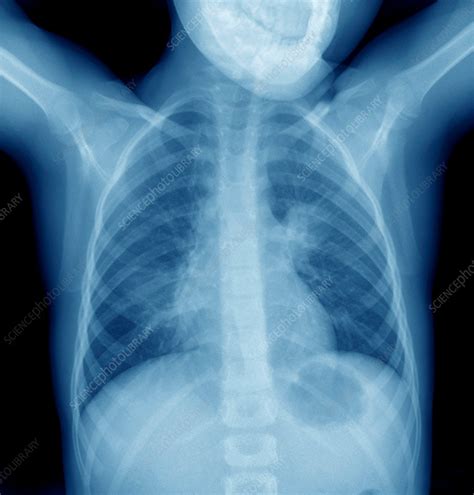 Lobar Pneumonia Lung X Ray Stock Image C037 2804 Science Photo