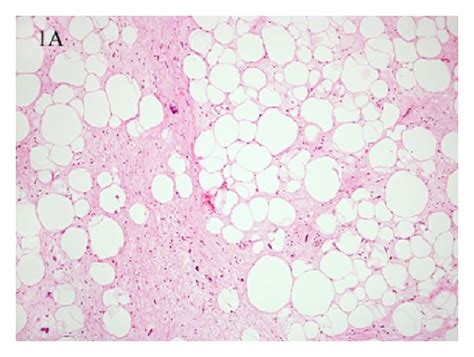 A Well Differentiated Liposarcoma WDL This Typical Example Shows