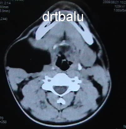 Tutorials in otolaryngology: A case of huge external laryngocele