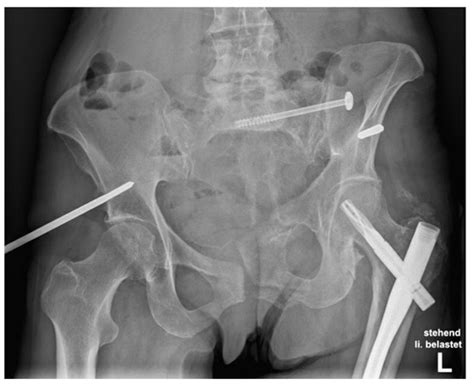 Jcm Topical Collection Pelvic Instability Currents Insights