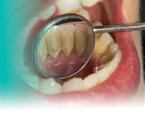 Tártaro nos dentes como surgem como prevenir e como tratar