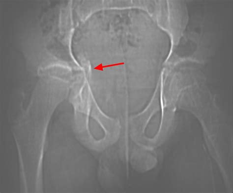 Growth Plate Fracture Causes Types Symptomstreatment