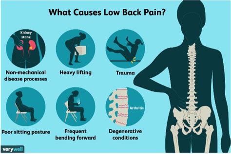 What Causes Lower Back Pain? - Strive! Physical Therapy Centers