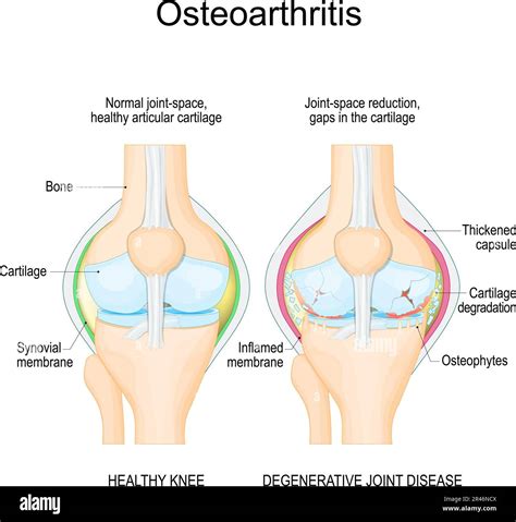 Articular Cartilage Osteoarthritis