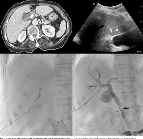 Figure From Effectiveness Of Ultrasound Guided Percutaneous