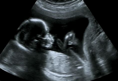 Pregnant Ultrasound – Telegraph