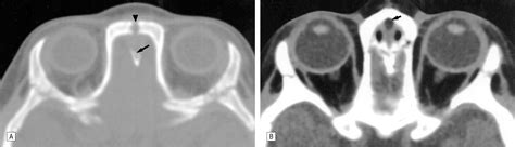 The Presentation And Management Of Nasal Dermoid A 30 Year Experience