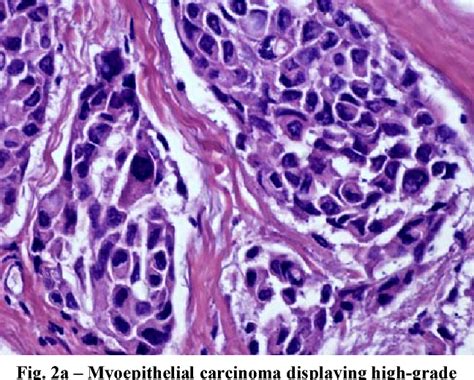 Figure From Soft Tissue Myoepithelial Carcinoma Semantic Scholar